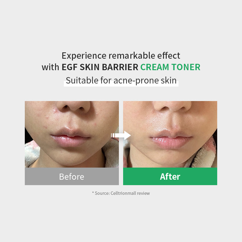 Zipiderm EGF Skin Barrier Cream Toner Tónico Hidratante Reparador De Barrera 150 ml | Tónico Facial
