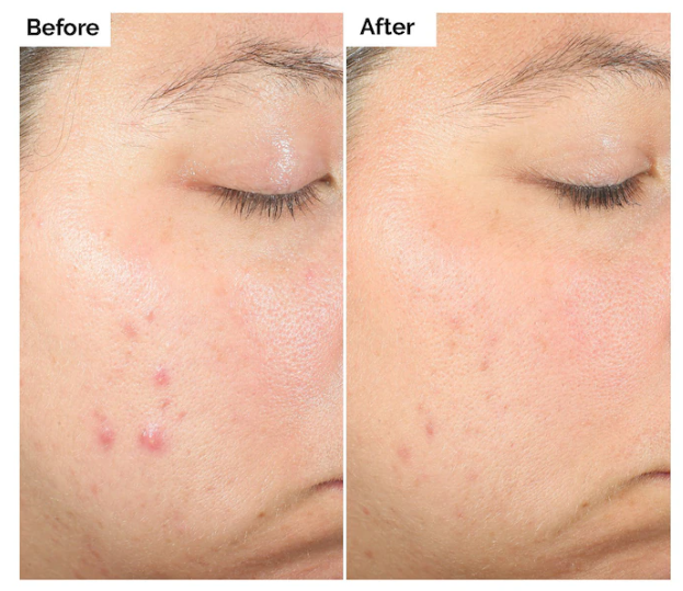 The Ordinary Salicylic Acid 2% Exfoliating Blemish Solution image 1