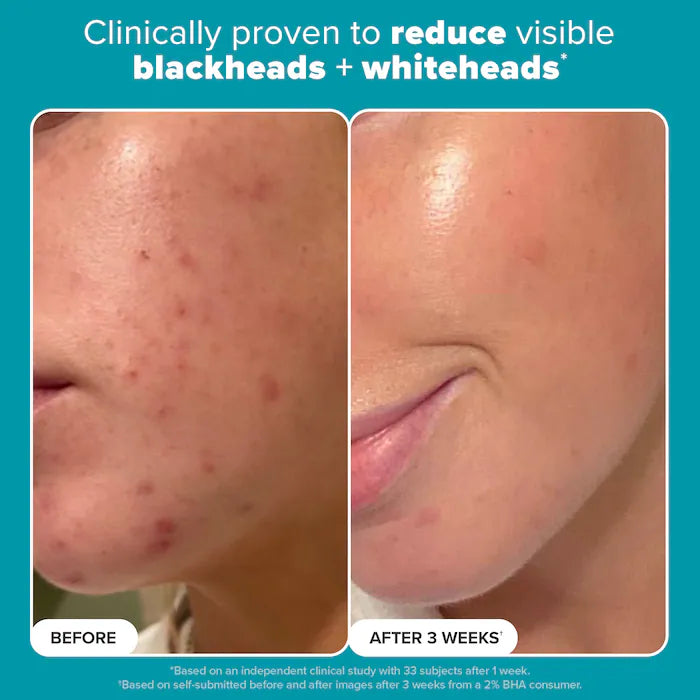 BAJO PEDIDO - Paula’s Choice Skin Perfecting 2% BHA Exfoliating Toner — Exfoliante Líquido Con Ácido Salicílico Para Piel Más Suave y Libre De Imperfecciones (118 ml)