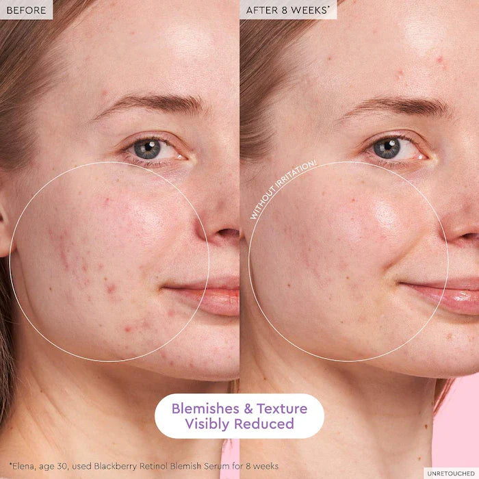 BY ORDER - Glow Recipe Blackberry Retinol Blemish Serum 30 ML — Retinol and Blackberry Serum to Treat Blemishes and Smooth Skin