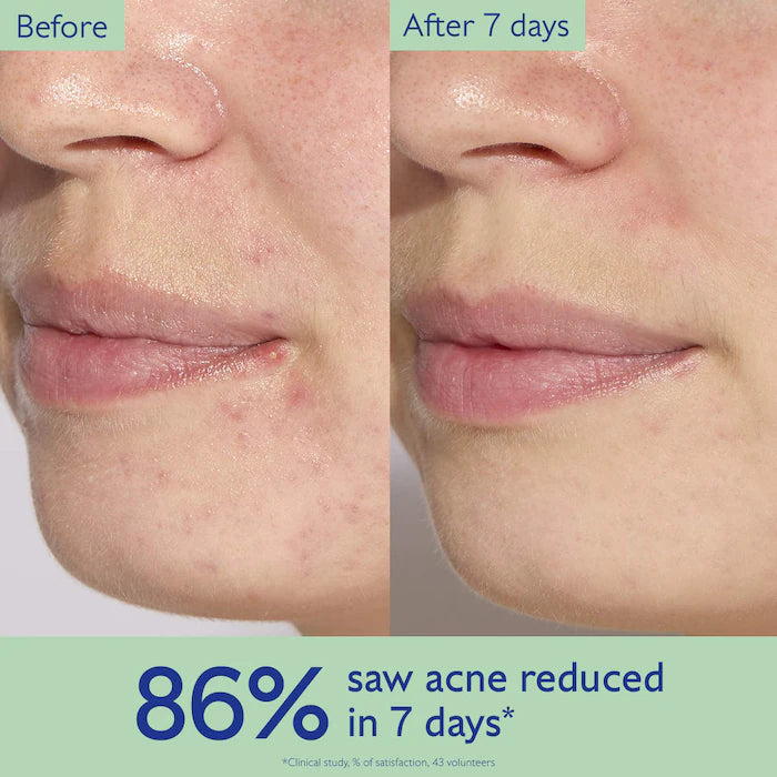 BAJO PEDIDO - Caudalie Vinopure Acne Serum 30 mL – Suero Antiacné Para Tratar Y Prevenir Imperfecciones