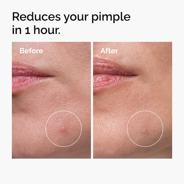 The Ordinary Sulfur 10% Powder-To-Cream Concentrate – Tratamiento Localizado Para Acné